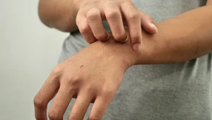 Objawem chorób wątroby może być m.in. swędzenie skóry. Wyjaśniamy, jakie jeszcze sygnały ze strony skóry mogą się pojawić, gdy wątroba choruje