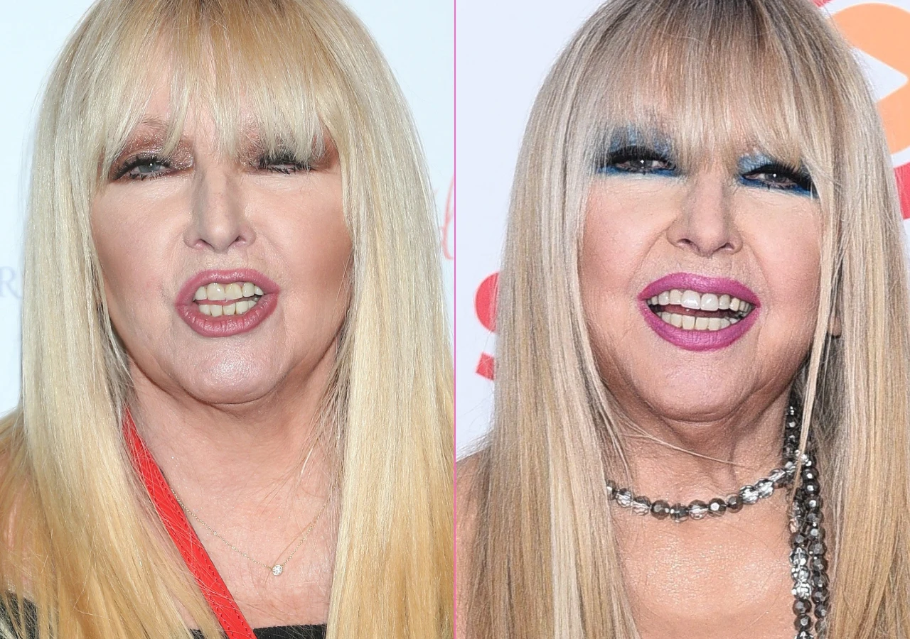 "Stare" (po lewej) i "nowe" (po prawej) zęby Maryli Rodowicz "Stare" (po lewej) i "nowe" (po prawej) zęby Maryli Rodowicz