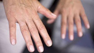 Drżenie samoistne może zwiastować chorobę Parkinsona lub nadczynność tarczycy. Często dotyczy dłoni i warg