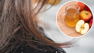 Powracający łupież jest twoją zmorą? Zamiast drogich szamponów używaj tego do mycia włosów