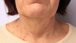 Co przy chorobie tarczycy doradziłby endokrynolog? Sprawdzamy