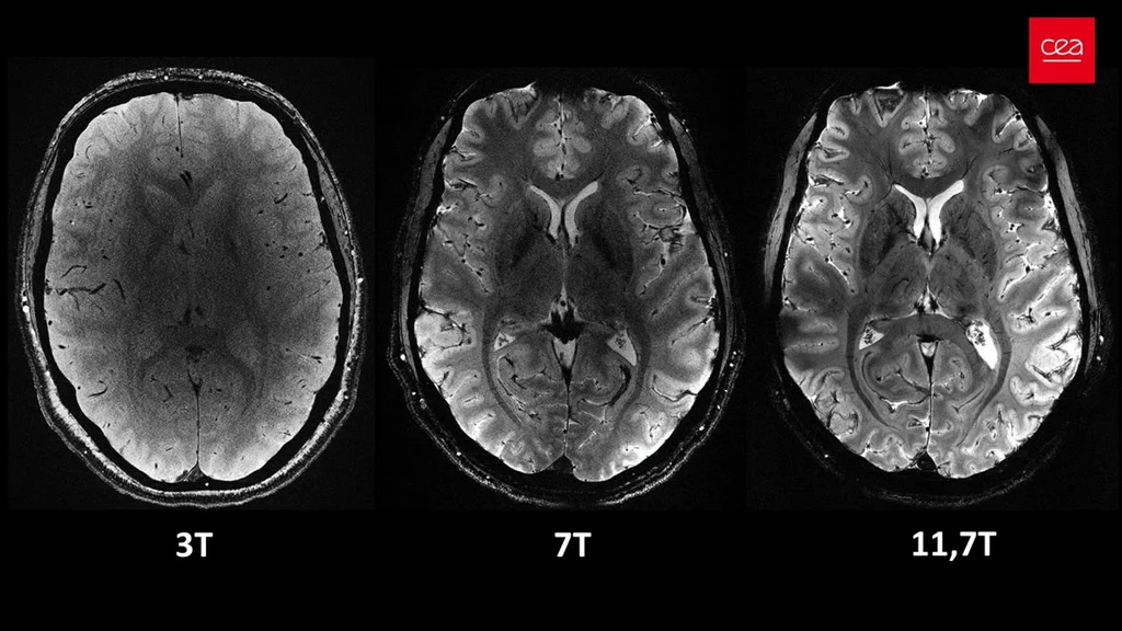 Porównawcze obrazy ludzkiego mózgu wykonane przez Iseult MRI przy różnych poziomach mocy, tj. 3,7 i 11,7 T