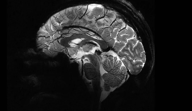 Ta choroba mózgu przeraziła Kanadę. Oni twierdzą, że… nie istnieje