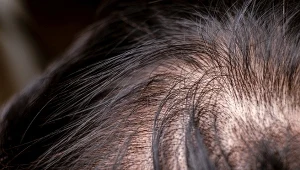 Łysienie androgenowe