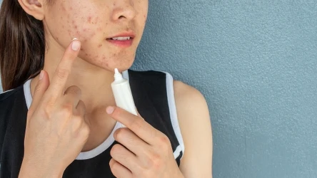Trądzik różowaty – odkryj, co naprawdę wywołuje ten problem skórny