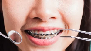 NFZ w przeważającej większości przypadków nie będzie partycypować w kosztach aparatu na zęby