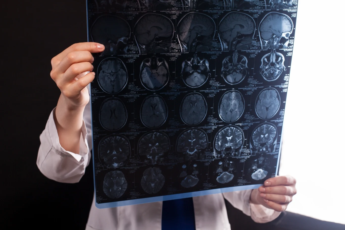 W przebiegu stwardnienia rozsianego dochodzi do uszkodzenia osłonek mielinowych w komórkach nerwowych W przebiegu stwardnienia rozsianego dochodzi do uszkodzenia osłonek mielinowych w komórkach nerwowych