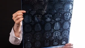 Lekarze już wiedzą. To dlatego kobiety są bardziej narażone na Alzheimera i stwardnienie rozsiane