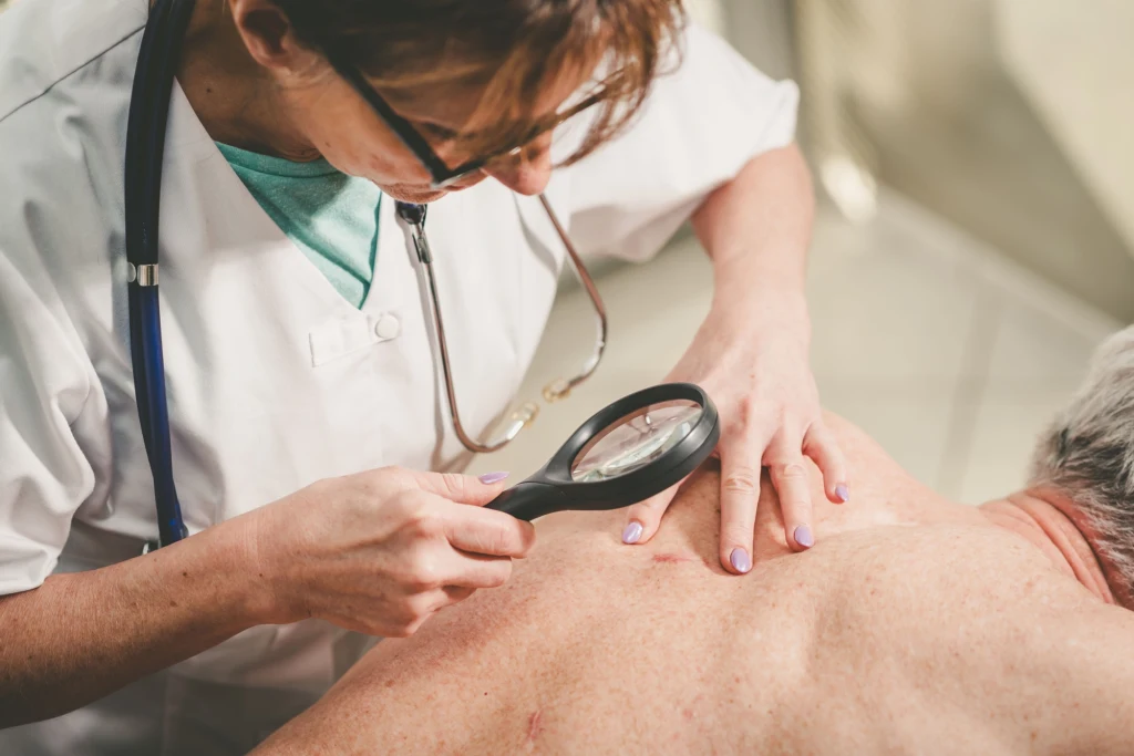 O problemach z wątrobą, mogą (ale nie muszą) świadczyć: naczyniaki, punkty rubinowe lub teleangiektazje (pajączki)  