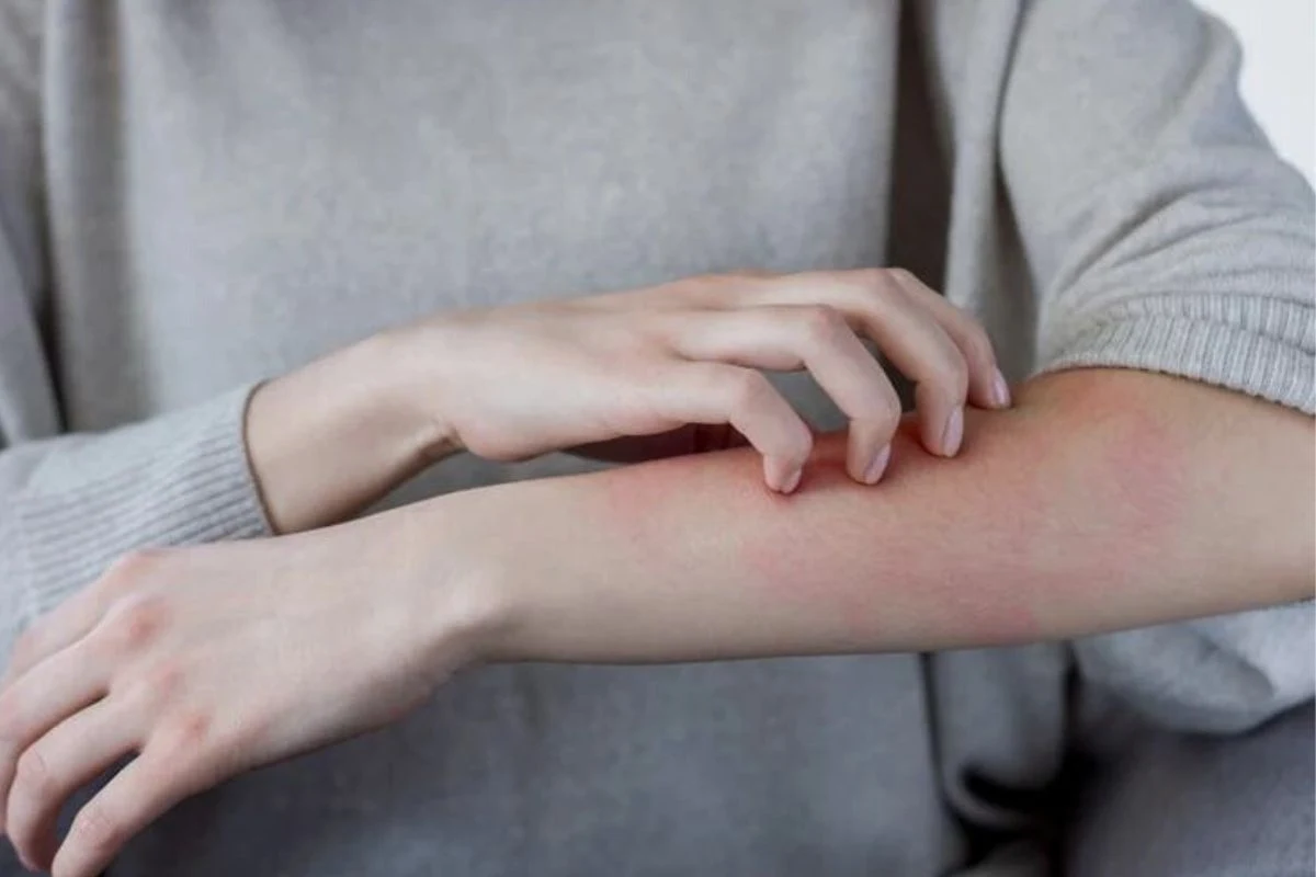 Po ekspozycji na skórę skóra osoby z alergią na słońce staje się czerwona i swędząca, może także wystąpić opuchlizna
