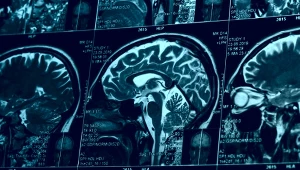 Leczenie "made ich China". Wiedzą, jak cofnąć Parkinsona