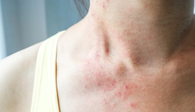 Zaczerwienienie, świąd i pieczenie skóry po kontakcie z biżuterią lub kosmetykiem mogą być objawem wyprysku kontaktowego