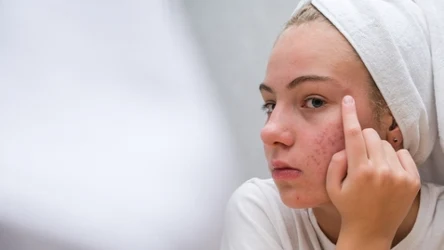 Jak pozbyć się wyprysków na twarzy?