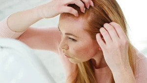 Skąd się bierze łysienie androgenowe? W jakim wieku występuje? Jak się objawia? Odpowiadamy