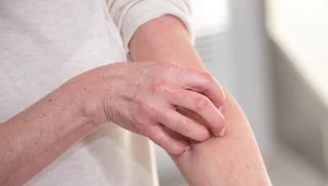 Pokrzywka - co ją może wywołać, jak się objawia? O tym warto wiedzieć