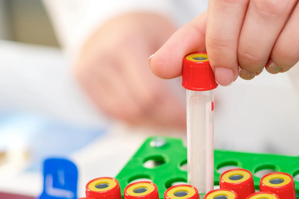 Osoby z grupą krwi AB częściej zapadają na choroby otępienne, metaboliczne oraz choroby układu krążenia