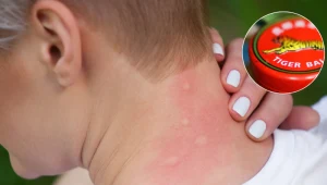 Posmaruj tą maścią miejsce po ugryzieniu owada. Stosowano ją już w PRL-u