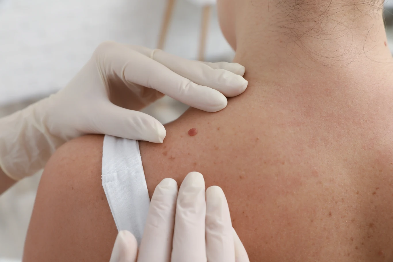 Jeśli zauważysz na skórze coś, co wyda ci się podejrzane, nie zwlekaj i udaj się do dermatologa Jeśli zauważysz na skórze coś, co wyda ci się podejrzane, nie zwlekaj i udaj się do dermatologa