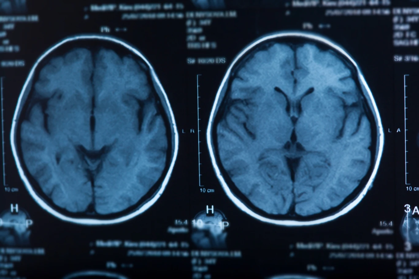 Wdychanie smogu w dzieciństwie może prowadzić do demencji w późniejszym życiu Wdychanie smogu w dzieciństwie może prowadzić do demencji w późniejszym życiu