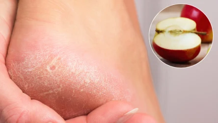 Masz popękane pięty? Ulgę przyniesie ci produkt z kuchennej szafki