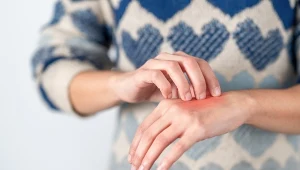 Wszystkim musiała tłumaczyć "To nie jest zakaźne". Po rozwodzie objawy łuszczycy zniknęły...