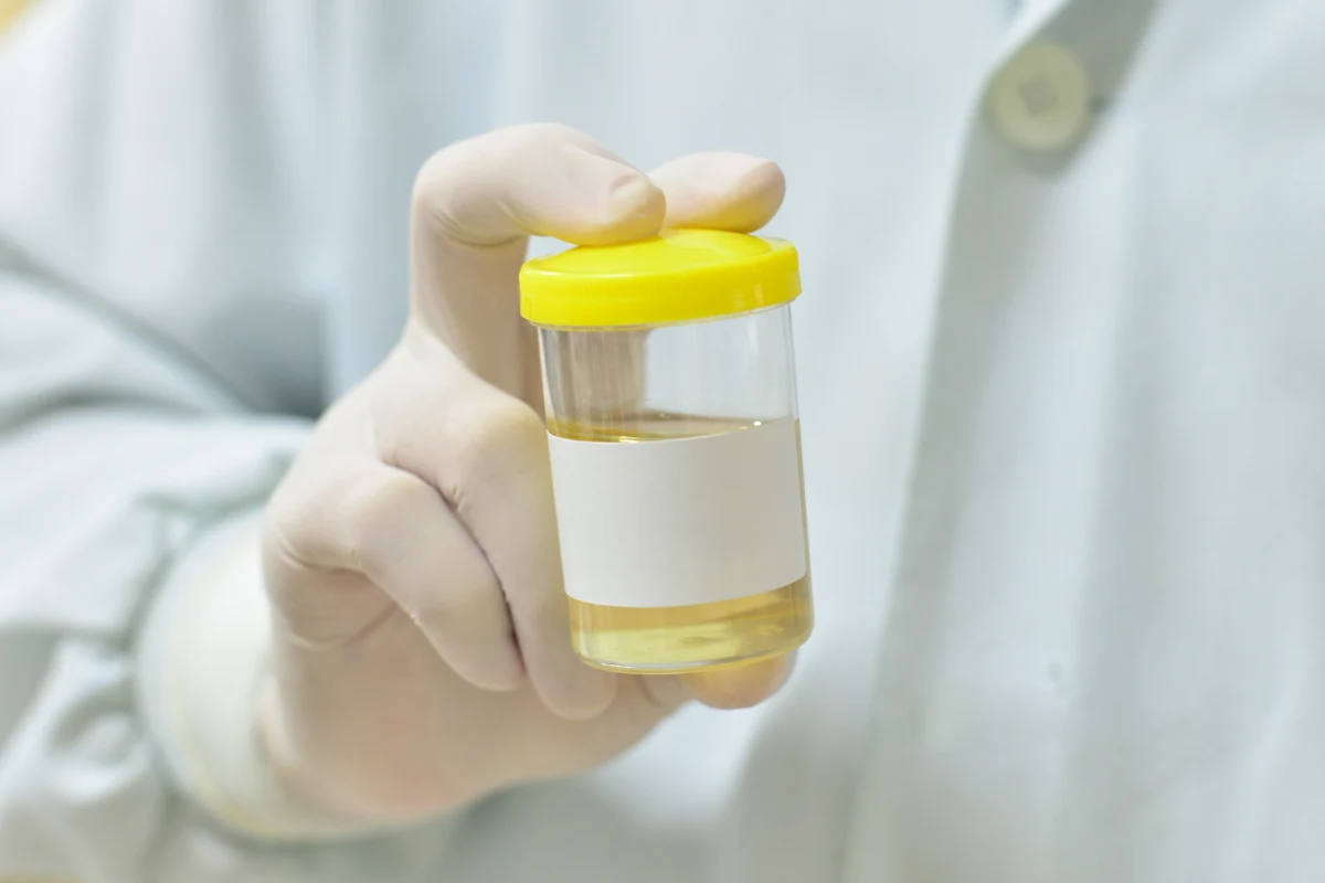 Wystarczy próbka moczu. Nowy test wykrywa ponad 9 na 10 przypadków raka pęcherza Dłoń w rękawiczce trzyma pojemnik z żółtym wieczkiem i próbką moczu przeznaczoną do badania laboratoryjnego.