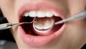 Kamień nazębny to zmineralizowana płytka nazębna