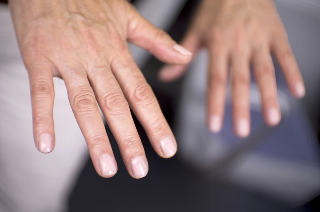 Zimne dłonie i stopy to częsty objaw niedoczynności tarczycy. Zwróć też uwagę na bladość skóry