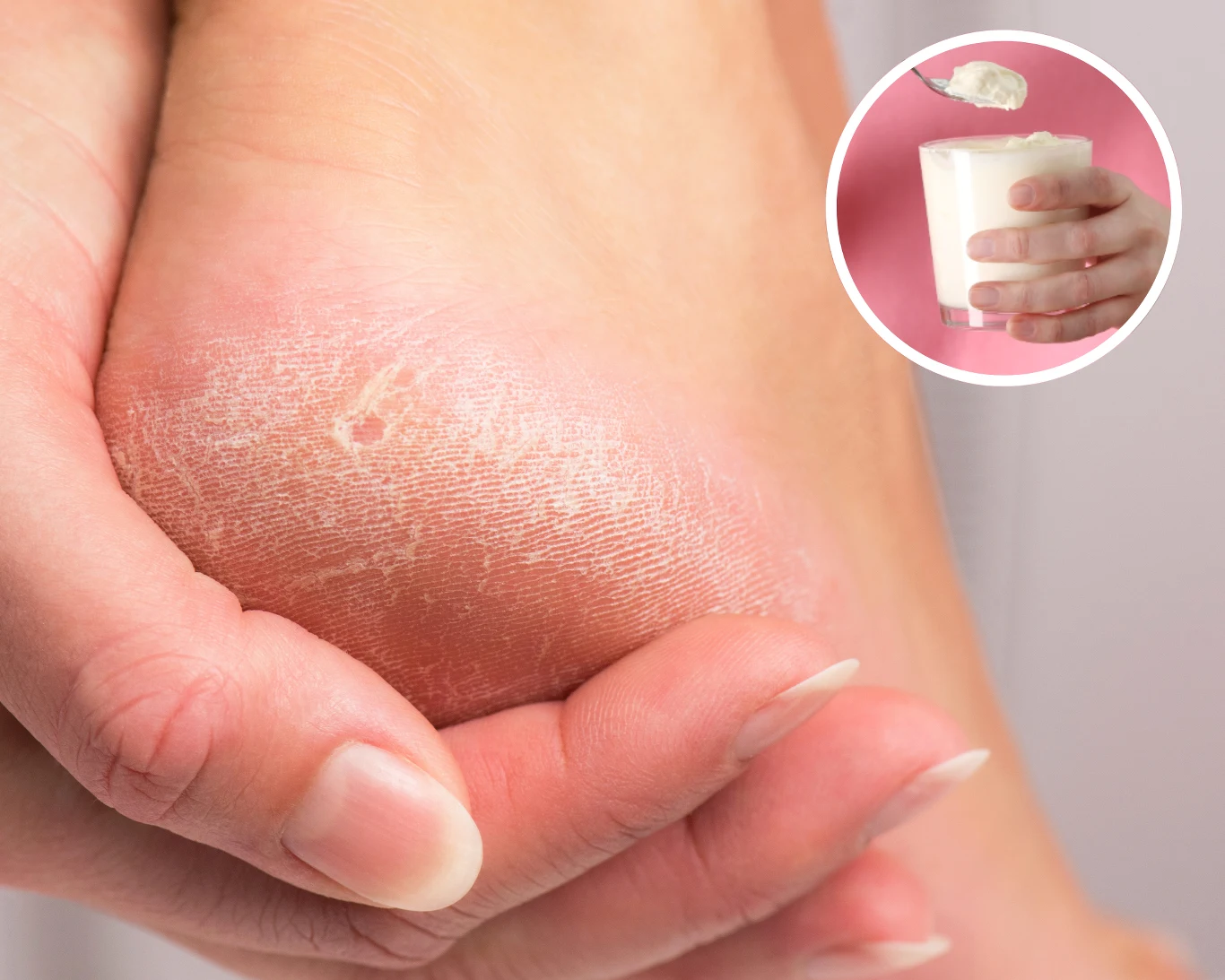 Wiedziałeś, że jogurt albo serek homogenizowany to świetne domowe sposoby na suche i szorstkie stopy? Wiedziałeś, że jogurt albo serek homogenizowany to świetne domowe sposoby na suche i szorstkie stopy?