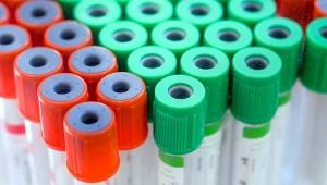 Regularne badania krwi pomagają wcześnie wykryć nieprawidłowy poziom kwasu moczowego