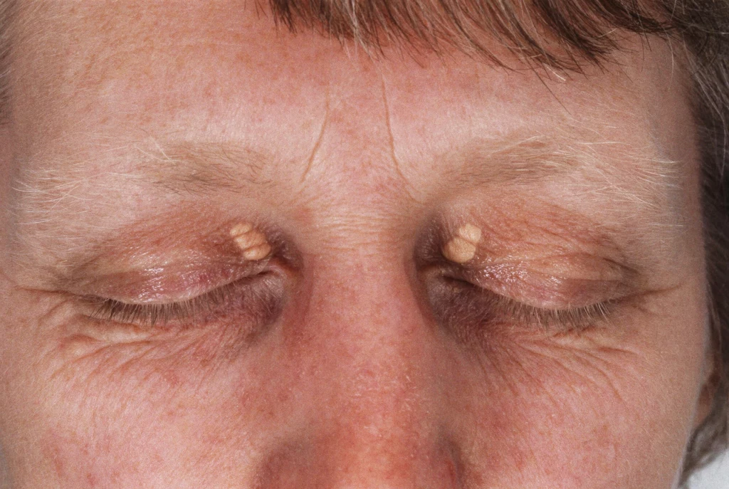 Xanthelasma to charakterystyczne złogi cholesterolu znajdujące się pod skórą