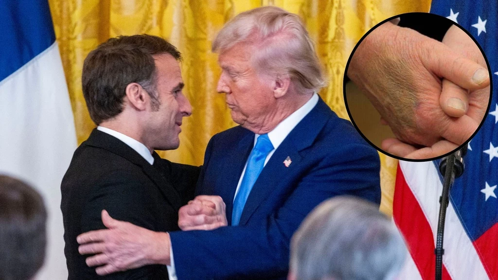 USA. Donald Trump z ogromnym siniakiem. Kuriozalne tłumaczenie Białego Domu USA. Donald Trump z ogromnym siniakiem. Kuriozalne tłumaczenie Białego Domu