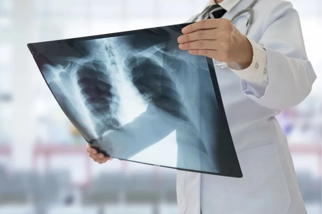 Do zdiagnozowania gruźlicy konieczne jest wykonanie RTG płuc oraz posiew plwociny chorego Do zdiagnozowania gruźlicy konieczne jest wykonanie RTG płuc oraz posiew plwociny chorego