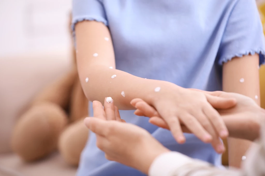 Zanim na ciele pojawi się wysypka, choremu na ospę dokuczają m.in. gorączka oraz bóle głowy i mięśni Zanim na ciele pojawi się wysypka, choremu na ospę dokuczają m.in. gorączka oraz bóle głowy i mięśni