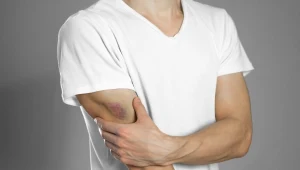 Stłuczenie, jak sobie z nim radzić?