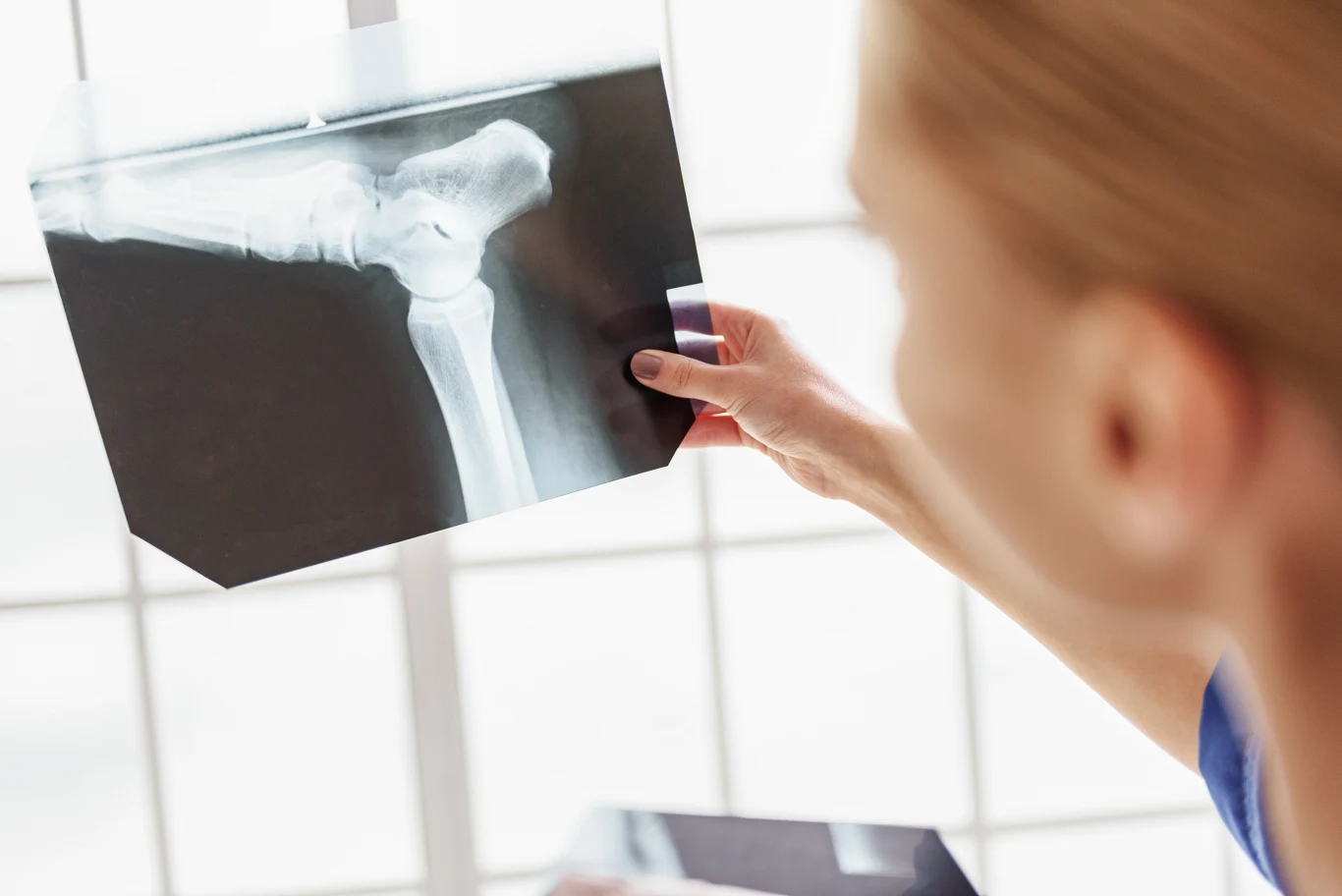Do czasu wystąpienia złamań osteoporoza przebiega bezobjawowo Do czasu wystąpienia złamań osteoporoza przebiega bezobjawowo