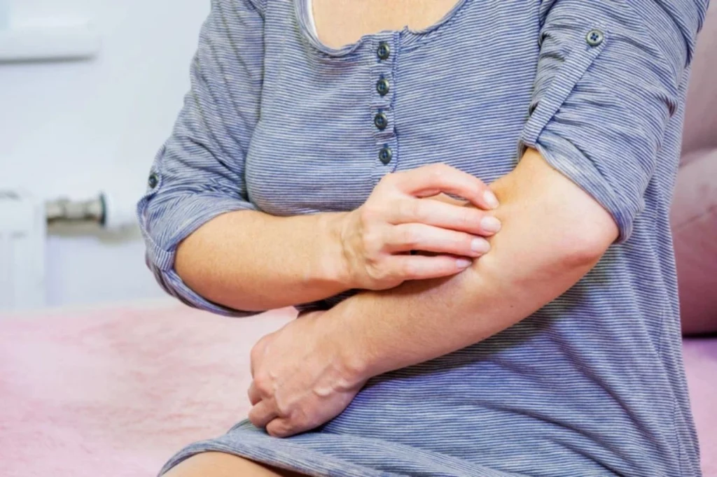 W cholestazie typowym objawem jest świąd skóry, który ni ustępuje mimo intensywnego drapania