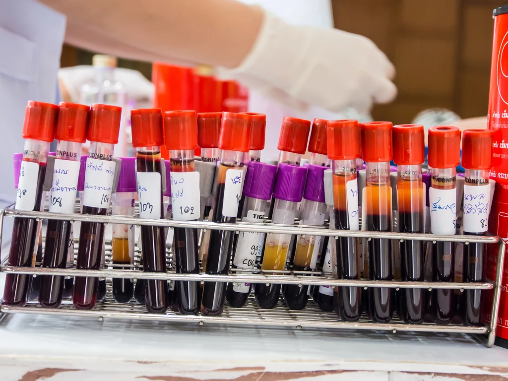 Niski poziom hemoglobiny w wynikach z badania krwi wskazuje na niedokrwistość. Aplikacja AI zastępuje pobranie krwi. Niski poziom hemoglobiny w wynikach z badania krwi wskazuje na niedokrwistość. Aplikacja AI zastępuje pobranie krwi.