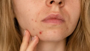 Pryszcze przed ważnym wydarzeniem? Ta maść za grosze usunie je w 1 noc 