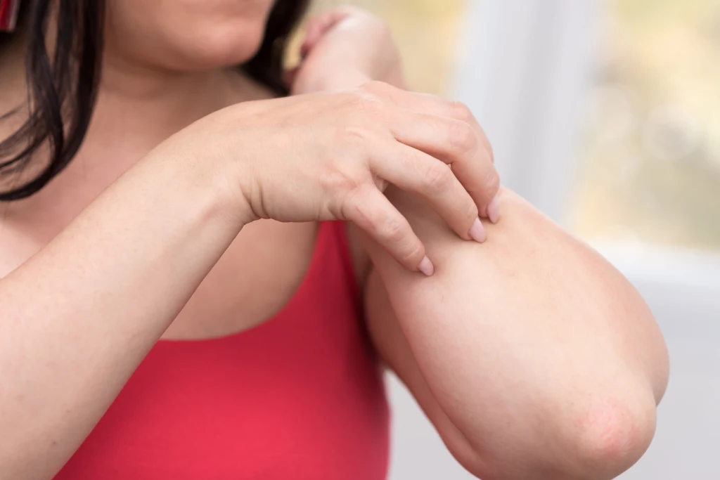 Użądlenie pszczoły może powodować świąd, ból lub obrzęk albo może stanowić bezpośrednie zagrożenie życia