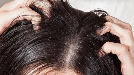 Przesuszoną skórę głowy ukoisz peelingiem cukrowym z olejem jojoba