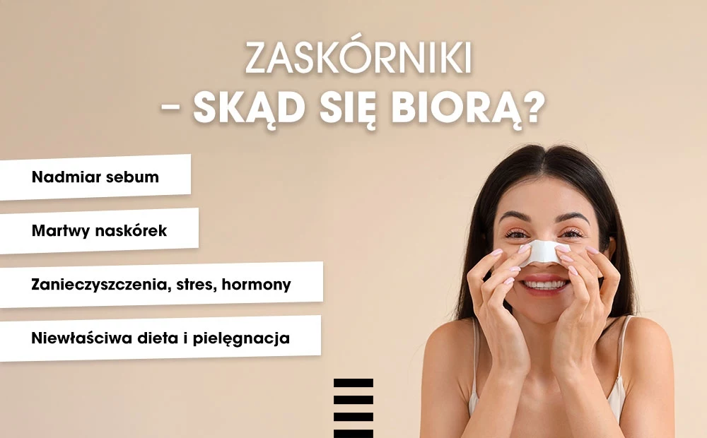 Co to są zaskórniki? Uśmiechnięta kobieta nakładająca plasterek oczyszczający na nos, po lewej stronie znajdują się wypunktowane przyczyny powstawania zaskórników takie jak nadmiar sebum, martwy naskórek, zanieczyszczenia, stres, hormony oraz niewłaściwa dieta i pielęgnacja.