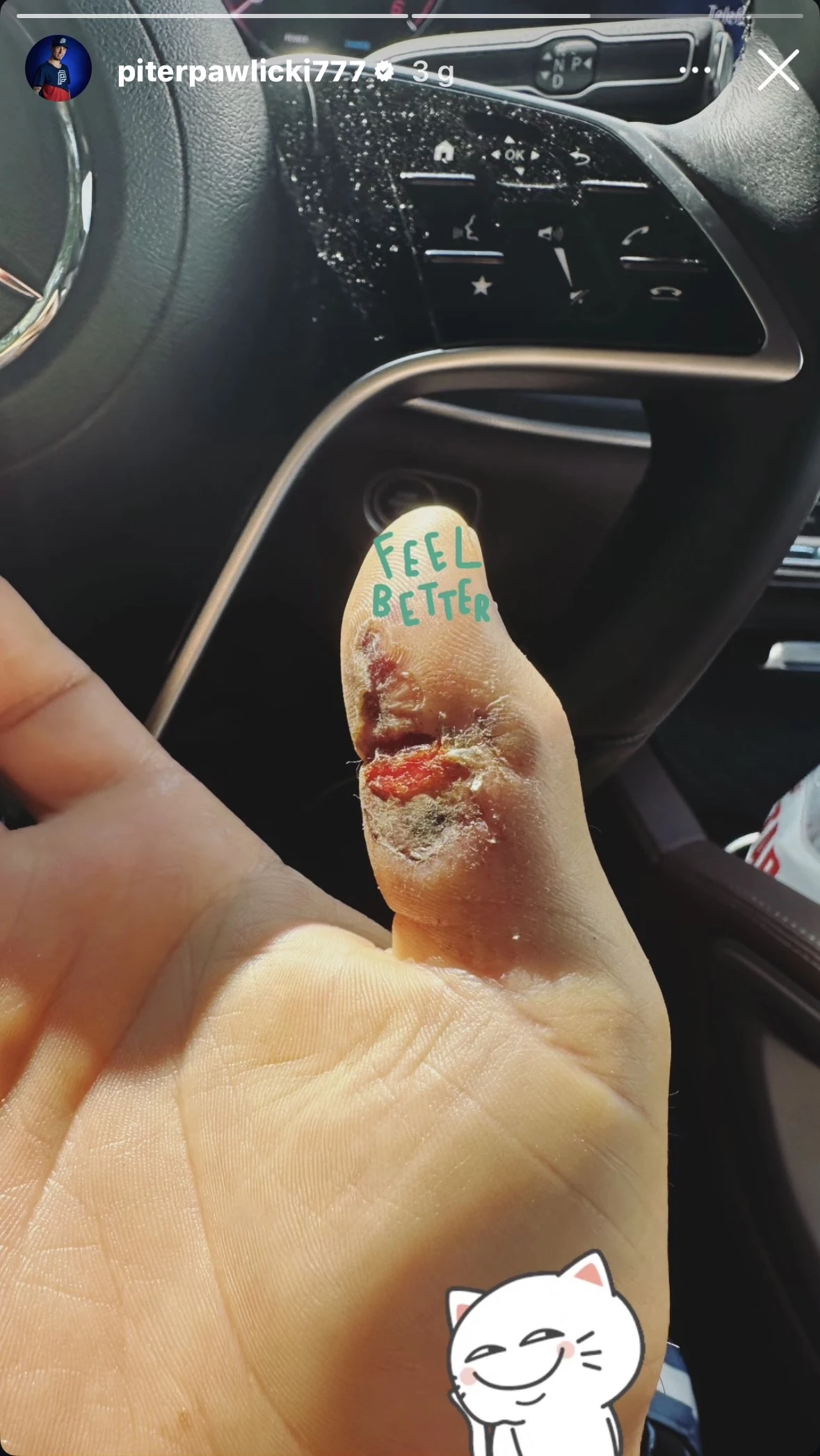 Opuszek palca Piotra Pawlickiego Zbliżenie na silnie zraniony kciuk z głęboką raną, strupami i widocznymi śladami infekcji, na tle kierownicy samochodu, na kciuku napis feel better oraz niewielka ilustracja kota.