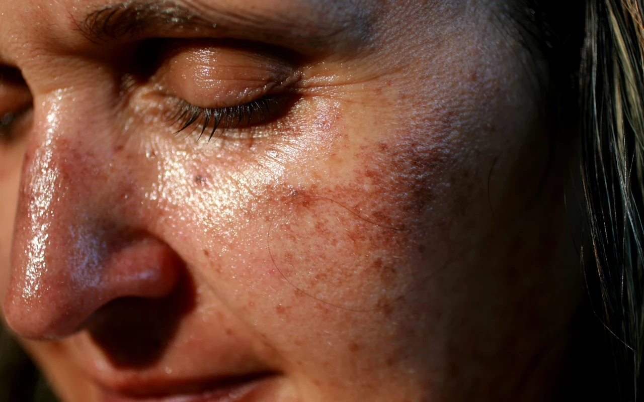 Osoby ze skłonnością do przebarwień powinny stosować silne filtry przeciwsłoneczne