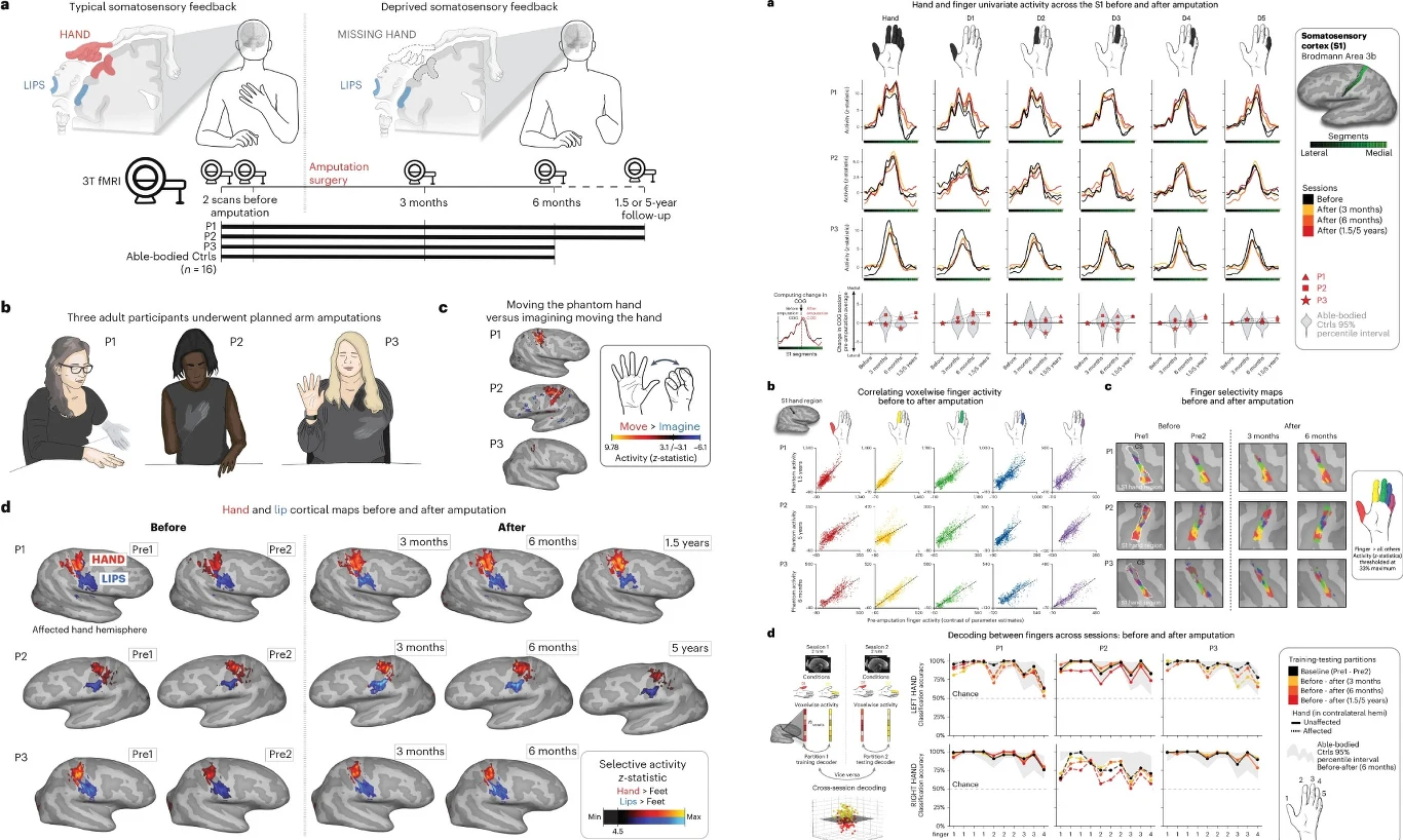 Diagramy, schematy oraz zdjęcia naukowe ilustrujące badania aktywności mózgowej związanej z amputacją ręki oraz odczuwaniem tzw. kończyny fantomowej; widoczne wizualizacje mózgu, wyniki badań, wykresy i fotografie uczestników.