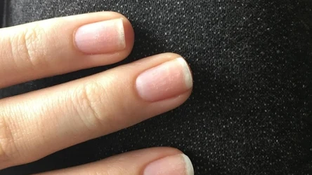 Co oznaczają białe linie na paznokciach?