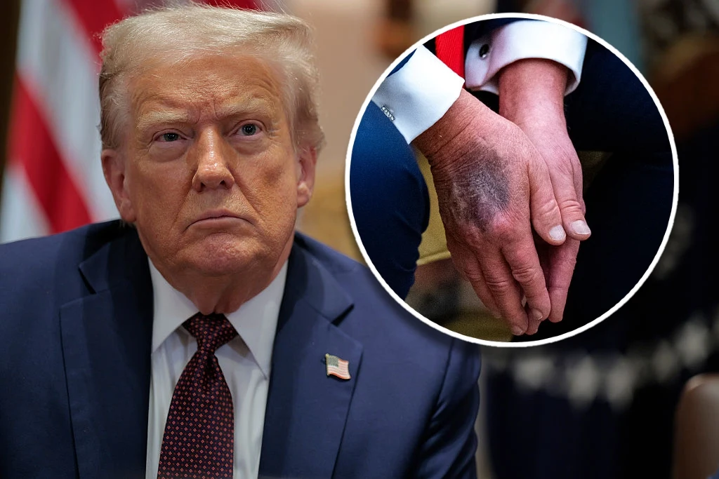 Nie milkną spekulacje na temat stanu zdrowia Donalda Trumpa Nie milkną spekulacje na temat stanu zdrowia Donalda Trumpa
