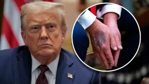 Co się dzieje ze zdrowiem Donalda Trumpa? Prezydent ucina spekulacje