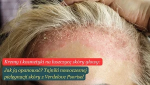 Przyczyny łuszczycy tkwią w nieprawidłowej odpowiedzi układu odpornościowego, który zaczyna atakować komórki własnego organizmu