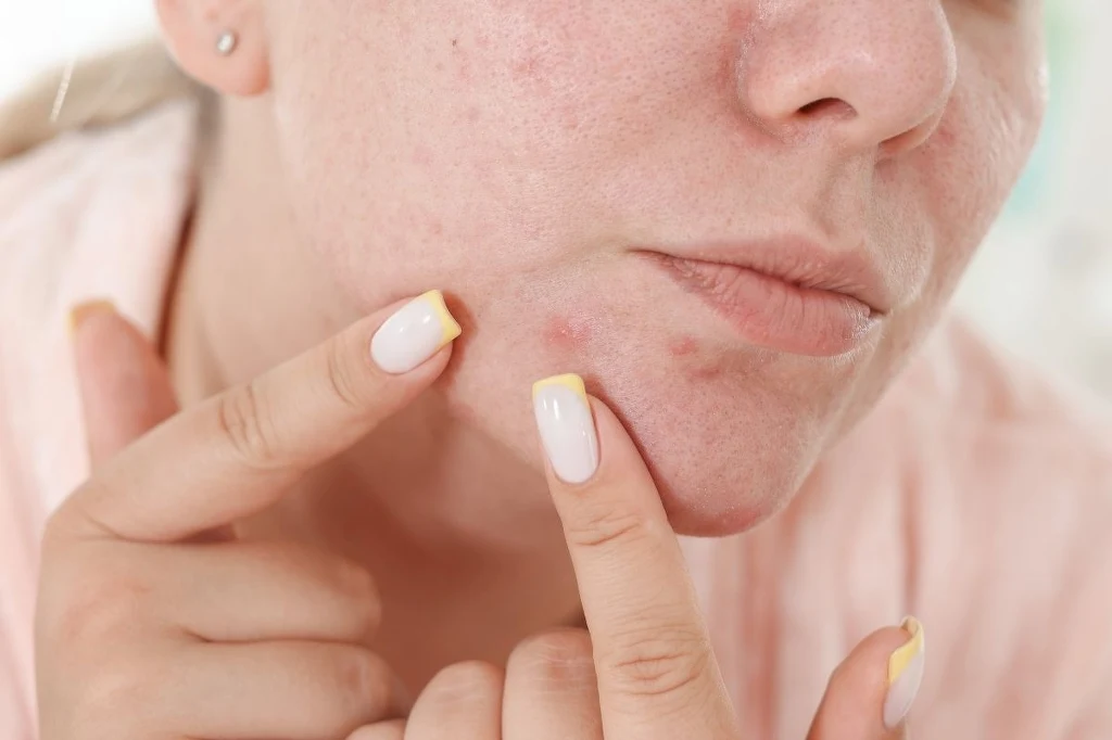 Kobieta z niedoskonałościami skóry na twarzy wyciskająca pryszcza w okolicy brody, dłonie z manicure w kolorze french.